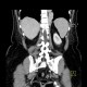 Hypoplasia of inferior vena cava, shunting by hemiazygous vein and vertebral veins: CT - Computed tomography